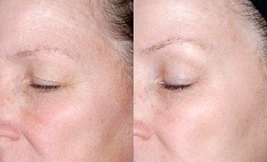 a szem körüli bőr fiatalítása a fotók előtt és után