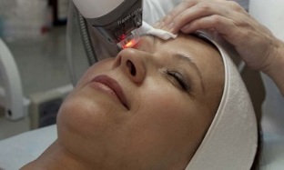blepharoplasztika a szem körüli bőr megfiatalítására