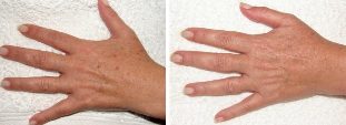 Az öregségi foltok eltávolításának eredménye a kezeken