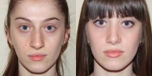 a plazma bőrfiatalítás előtt és után